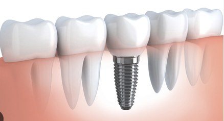 Ilustração de implante dentário